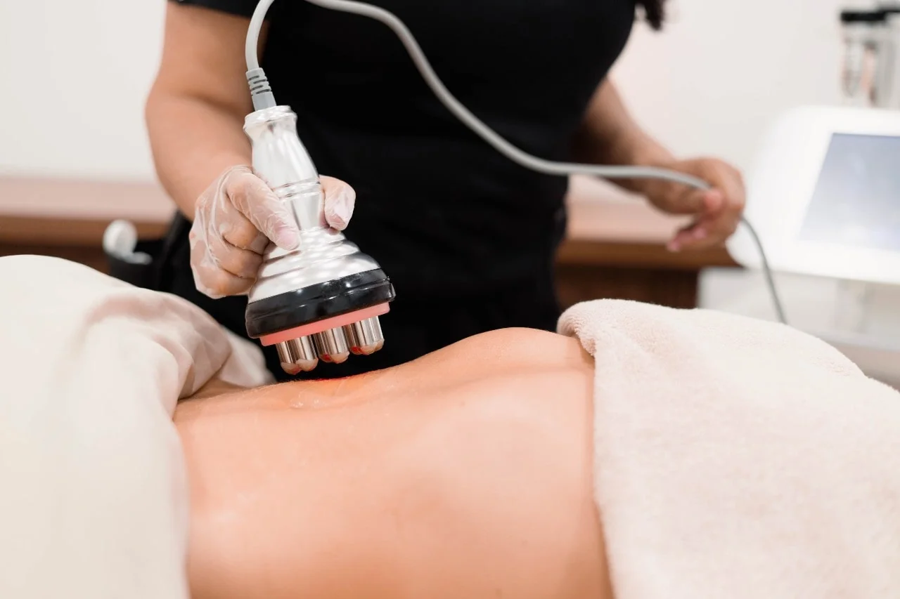 Radiofrequency body sculpting treatment