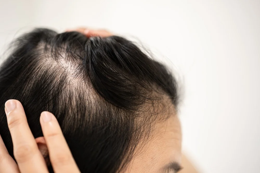 Androgenic Alopecia at Aliva Aesthetics, Vijayawada
