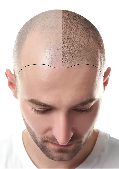 Scalp micropigmentation hairline restoration at Aliva Aesthetics
