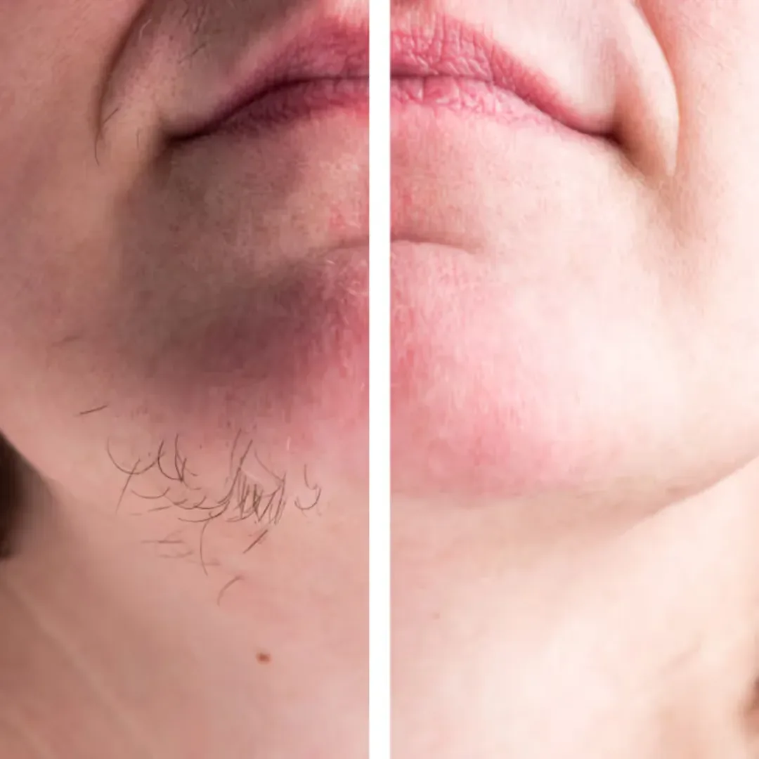Before and after laser hair reduction on the chin and upper lip at Aliva Aesthetics